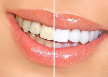 BloomBright™ Purple Teeth Whitening Gel
